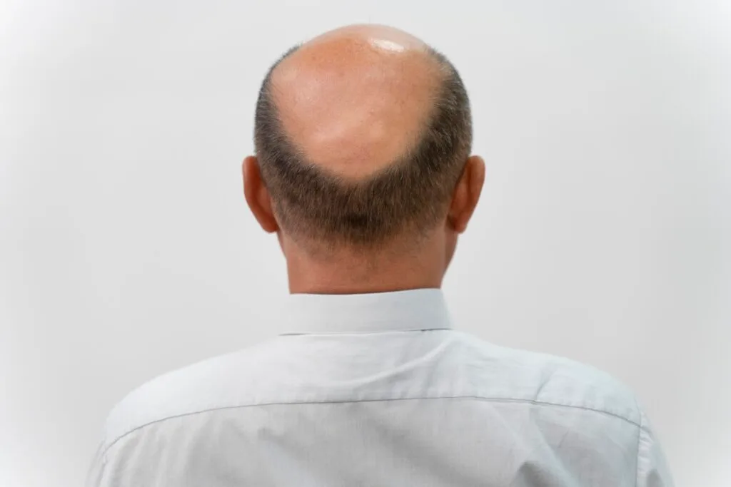 Saphir FUE Haartransplantation Behandlung