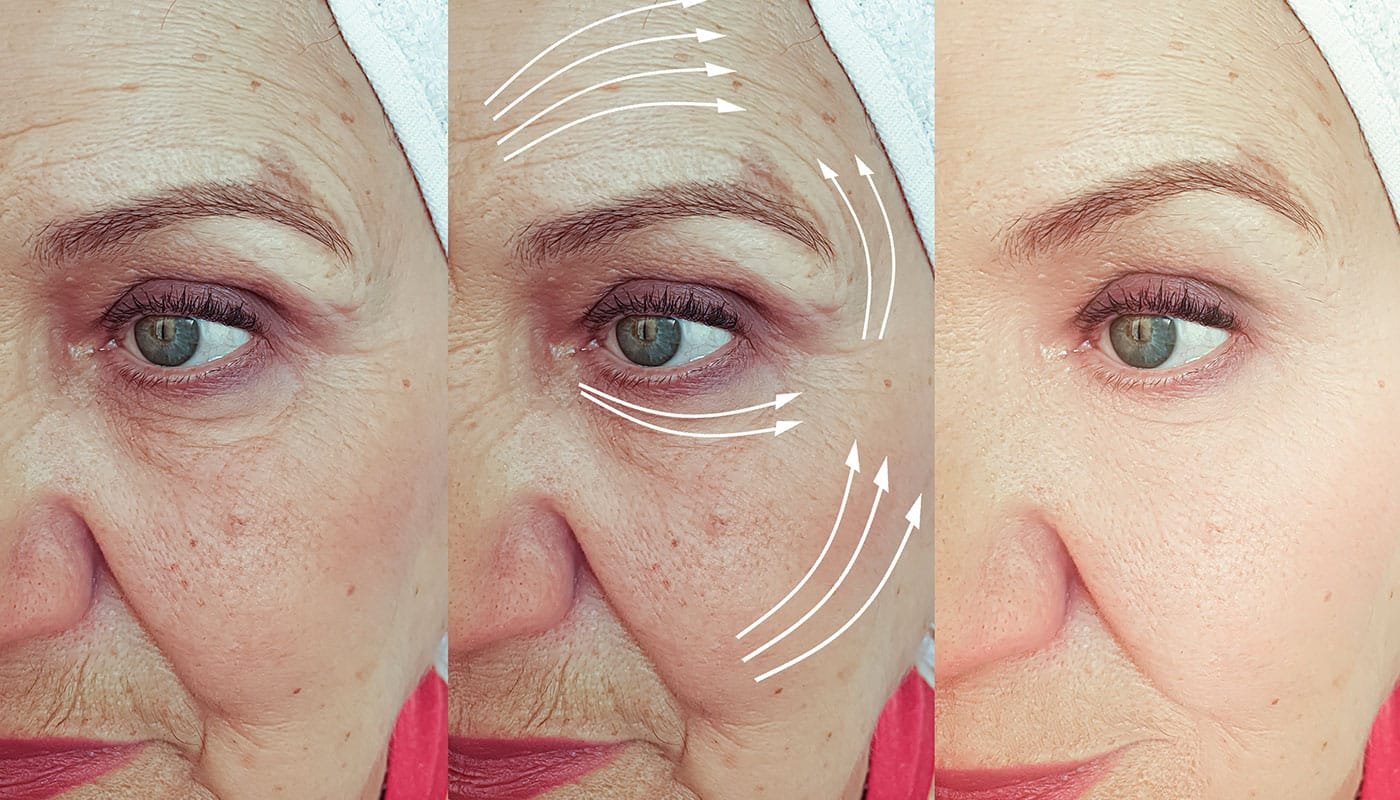 Frau faltet Gesicht botox behandlung