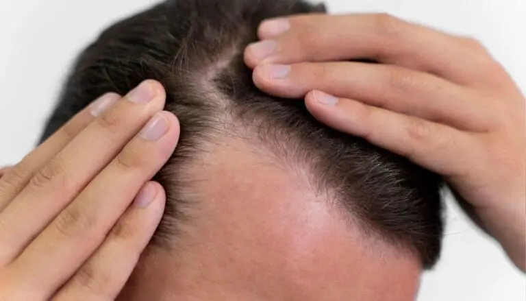PRP Haarbehandlung