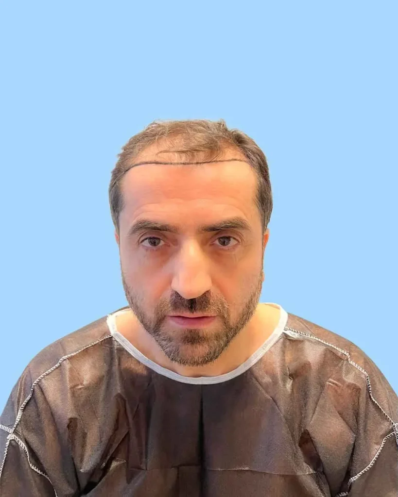Haartransplantation in Berlin – vorher-nachher Ergebnis eines Patienten
