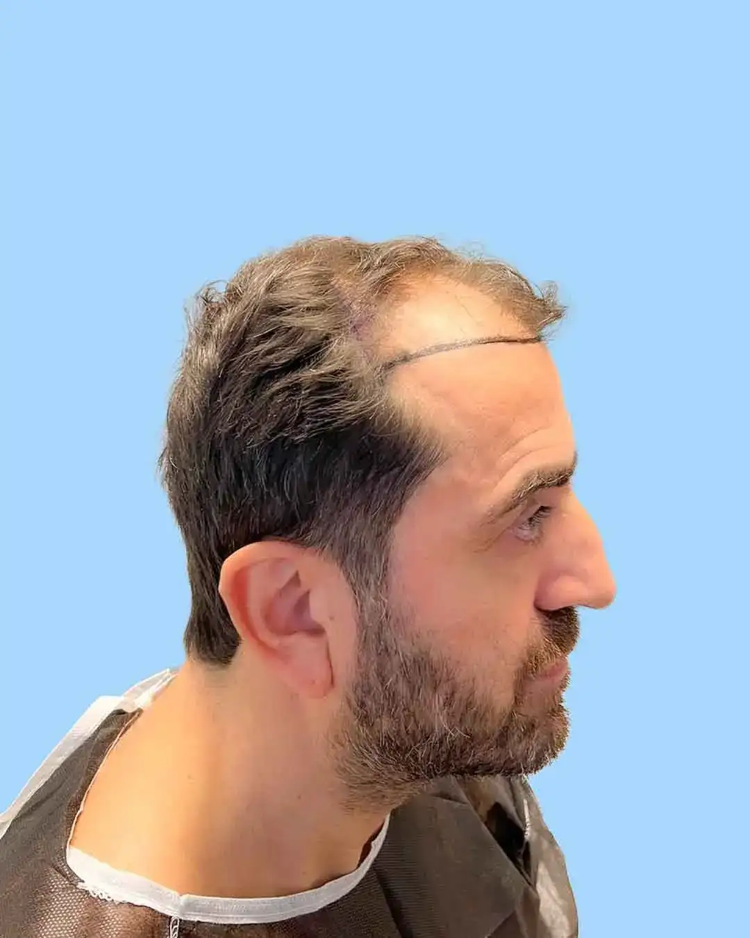 Natürliches Ergebnis nach einer Haartransplantation