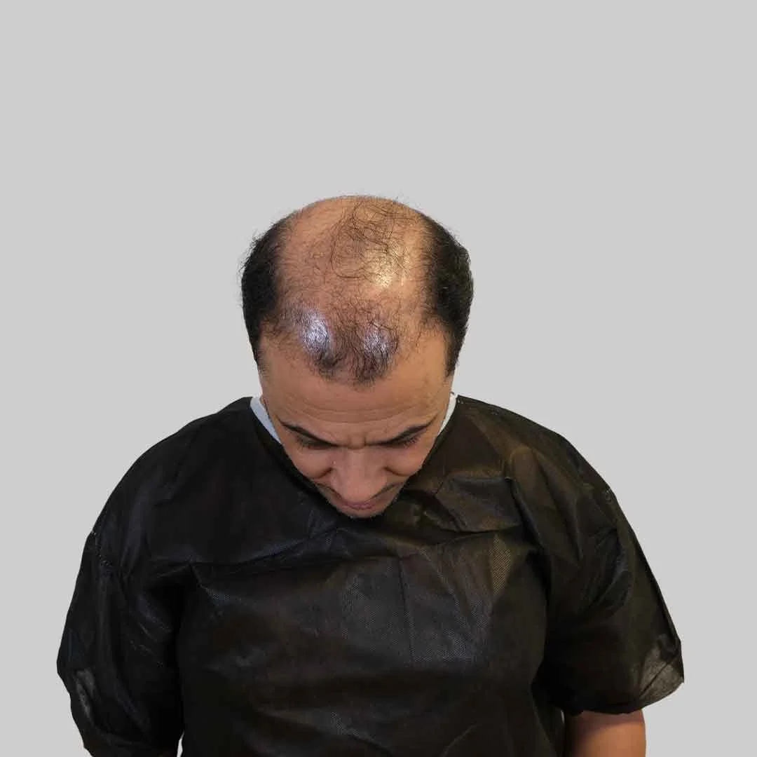 FUE Haartransplantation Vorher Nachher