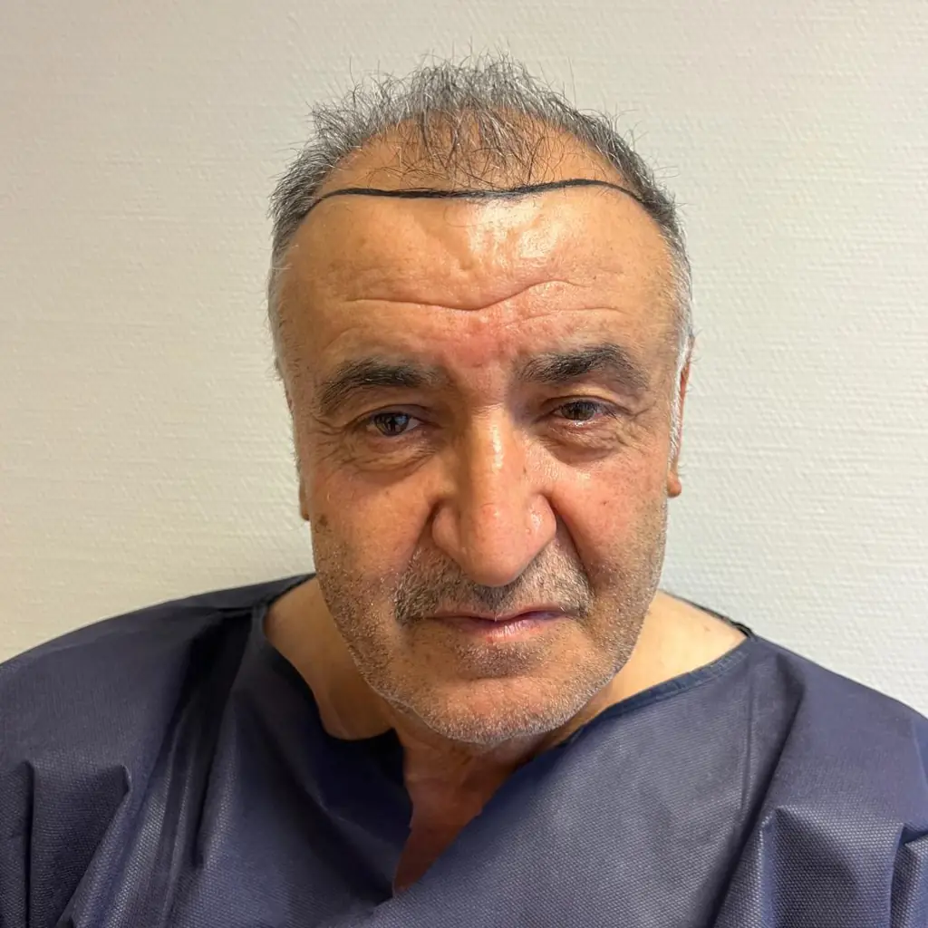 Haarlinie und Graft-Kalkulation