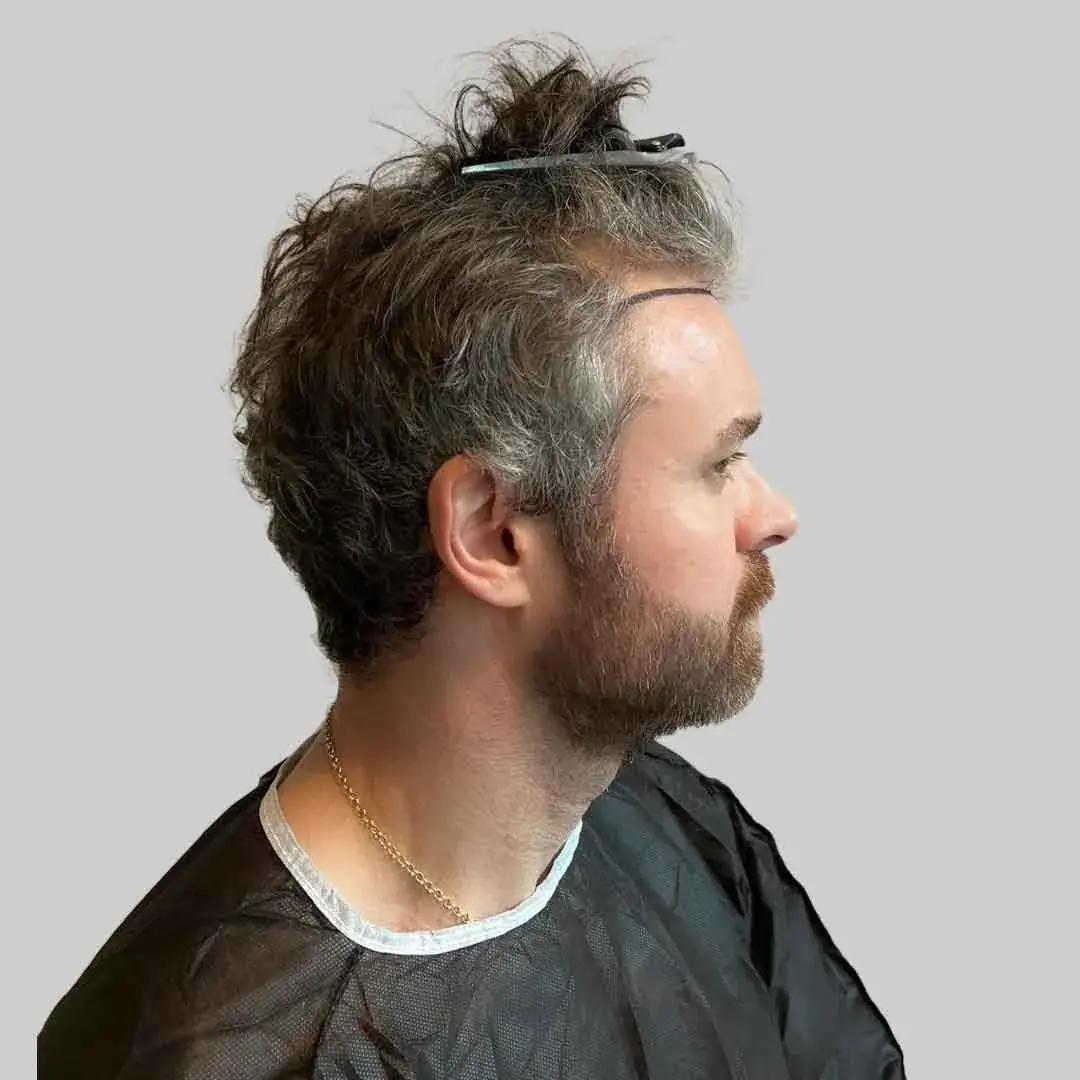 Saphir-FUE Vorher Nachher