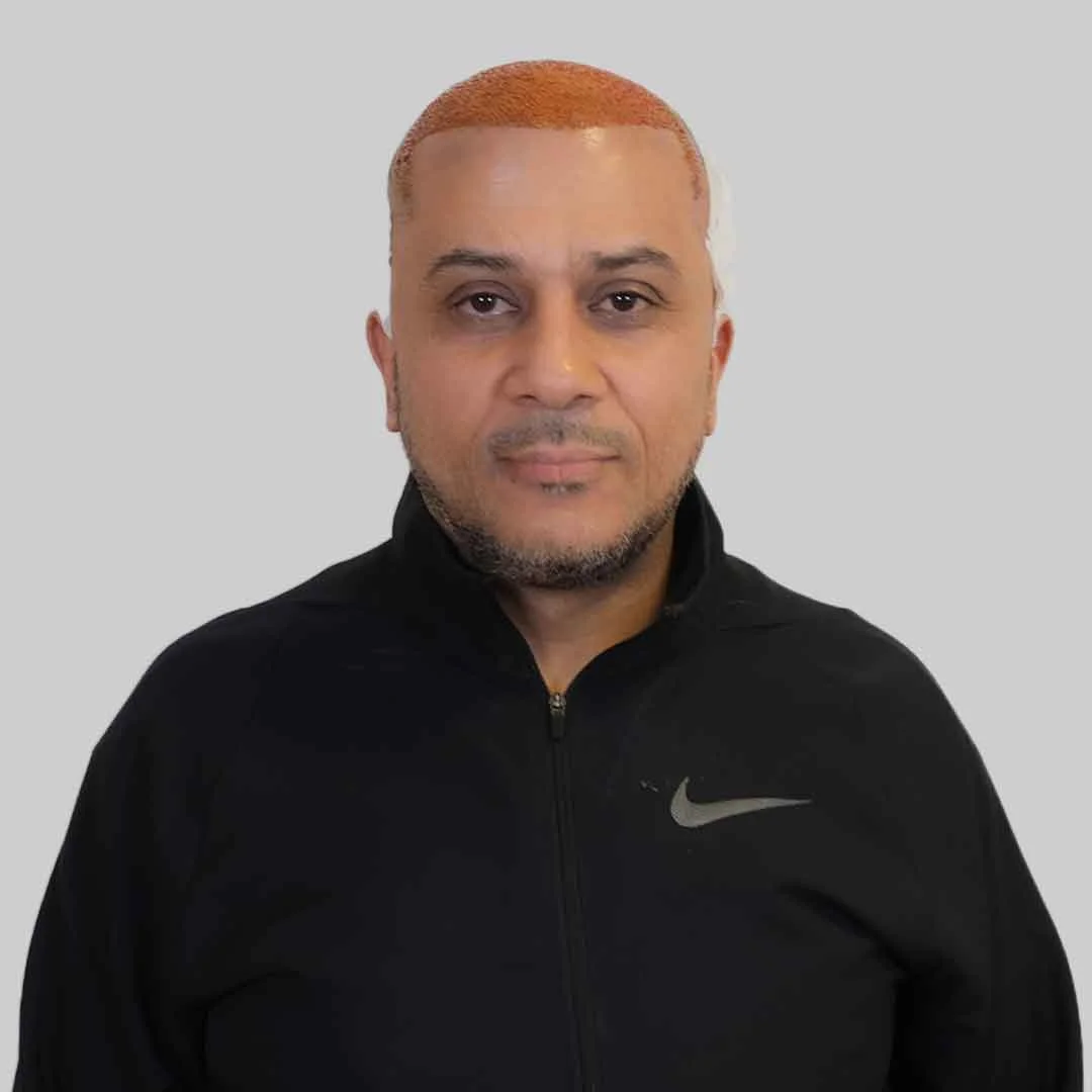 FUE Haartransplantation Vorher Nachher