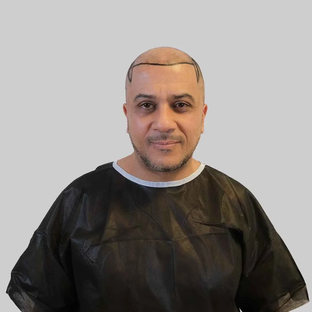 FUE Haartransplantation Vorher Nachher