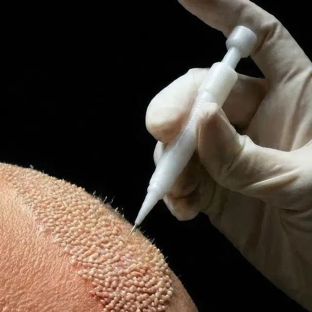 Einsetzen der Grafts mit dem Implanter Pen zwischen bestehenden Haaren – Ku'damm Aesthetic Berlin