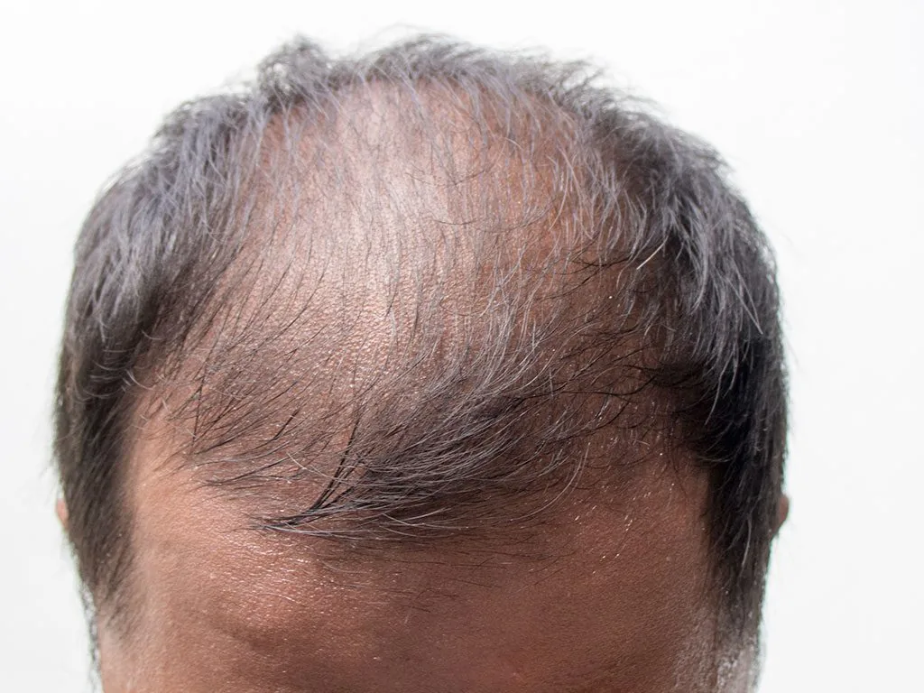 Erblich bedingter Haarausfall – Abklärung in Berlin