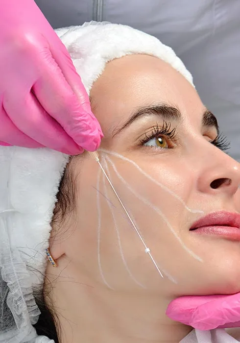 Fadenlifting Behandlung in Berlin bei Ku'damm Aesthetic