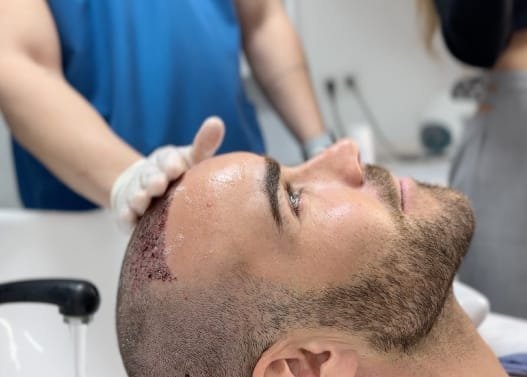 Saphirklinge im Einsatz bei einer FUE-Haartransplantation in Berlin