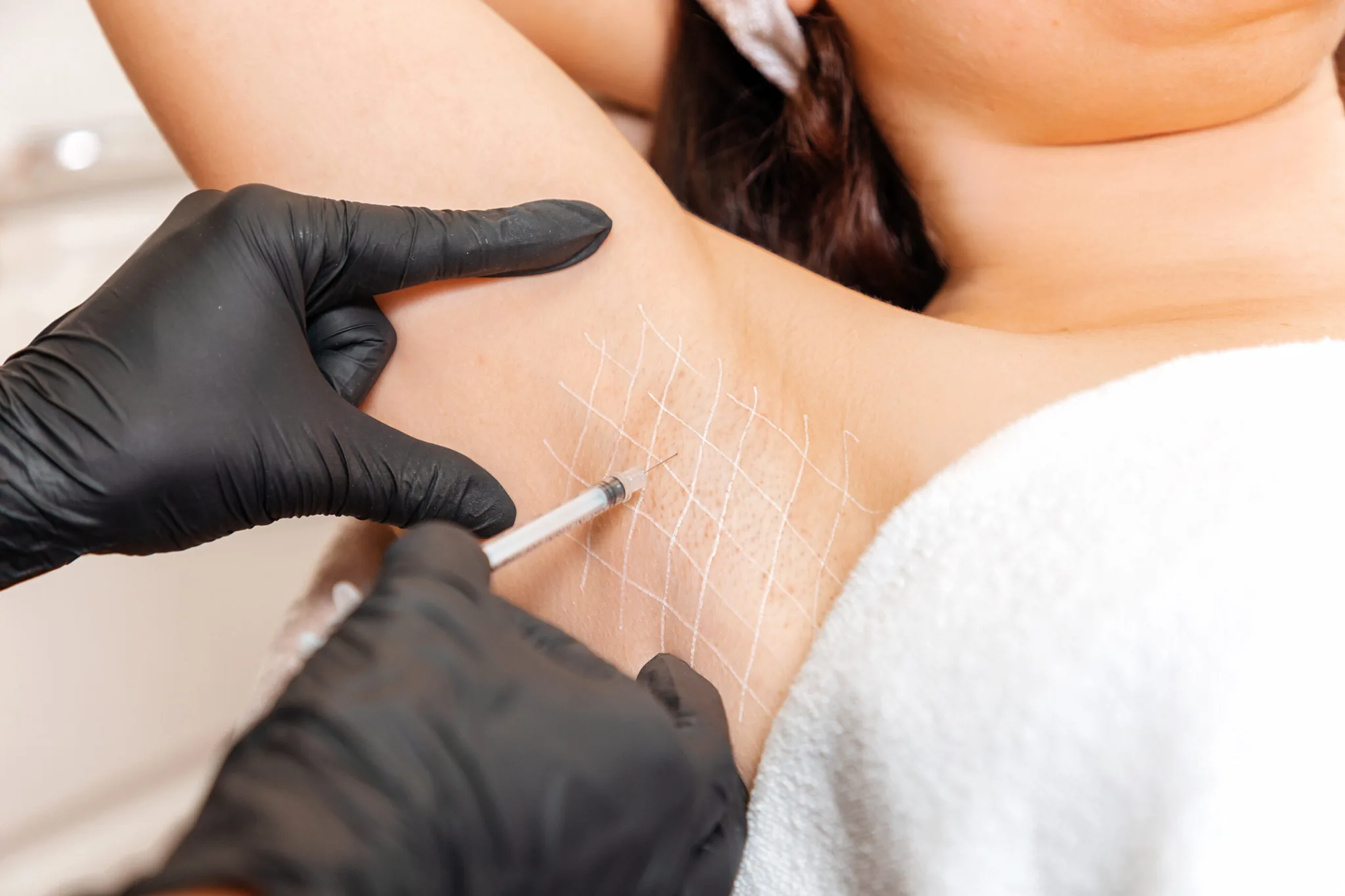 Botox-Behandlung der Achseln bei Hyperhidrose in Berlin