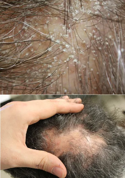 Untersuchung der Kopfhaut bei Haarausfall in Berlin