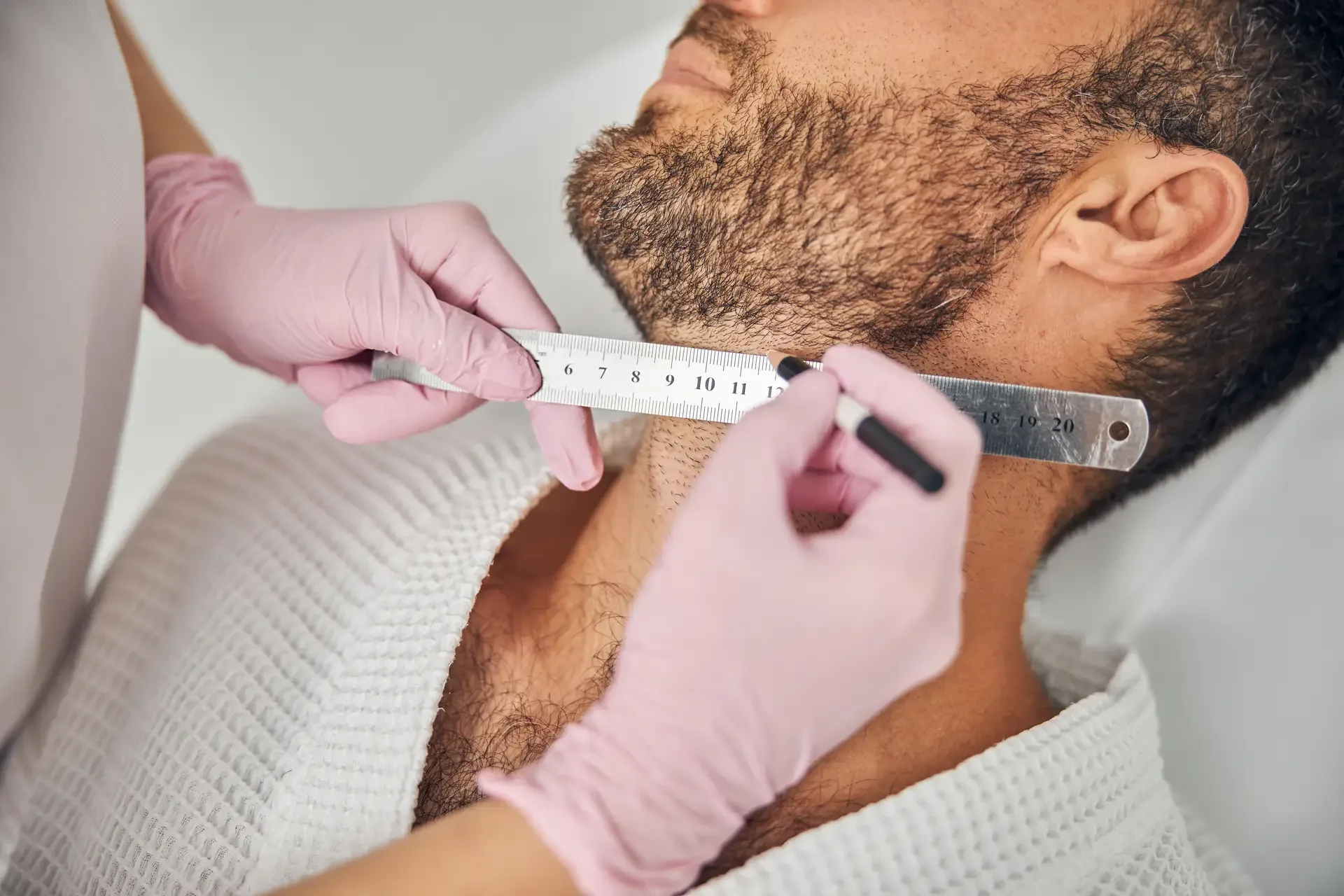 Planung von Winkel und Wuchsrichtung bei einer Barttransplantation in Berlin