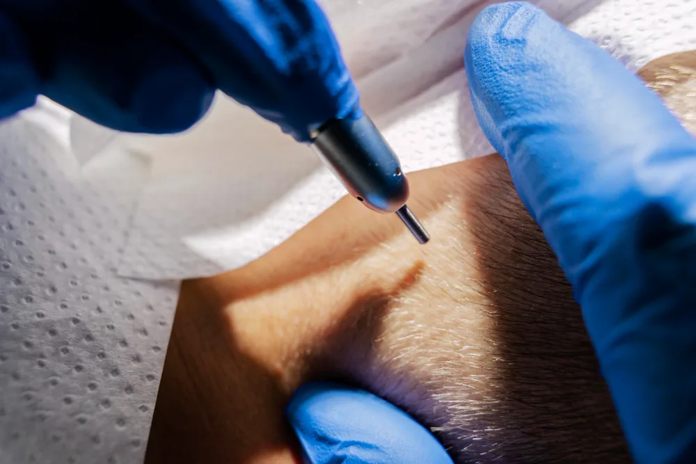 Entnahme der Grafts während einer Haartransplantation bei Ku'damm Aesthetic Berlin