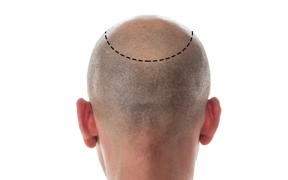 Lichtes Deckhaar – typisches Behandlungsareal einer DHI-Haartransplantation