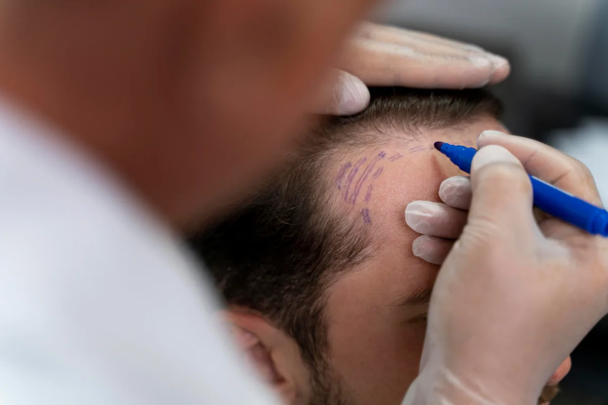 Beratung vor einer Haartransplantation – Planung und Analyse