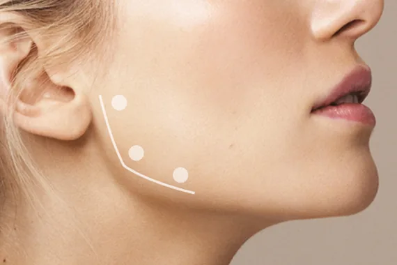 Masseter-Botox in Berlin: gegen Zähneknirschen und für eine schmalere Kieferlinie 4 Masseter-Behandlung gegen Zähneknirschen in Berlin